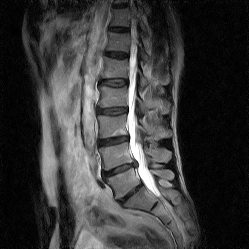 RMN L4-L5 dopo due mesi di terapia SynthéXer