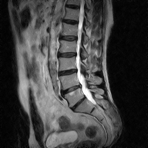 RMN L4-L5 prima della terapia SynthéXer