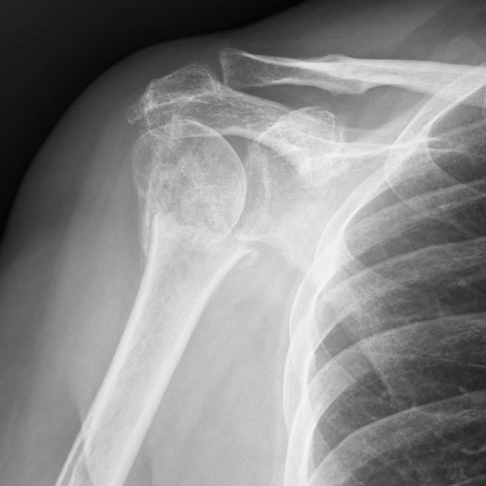 Radiografia della spalla dopo due mesi di terapia SynthéXer