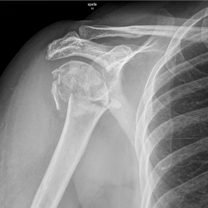 Radiografia della spalla con frattura dell’omero destro prima della terapia